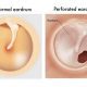 Ruptured Eardrum Hearing Loss